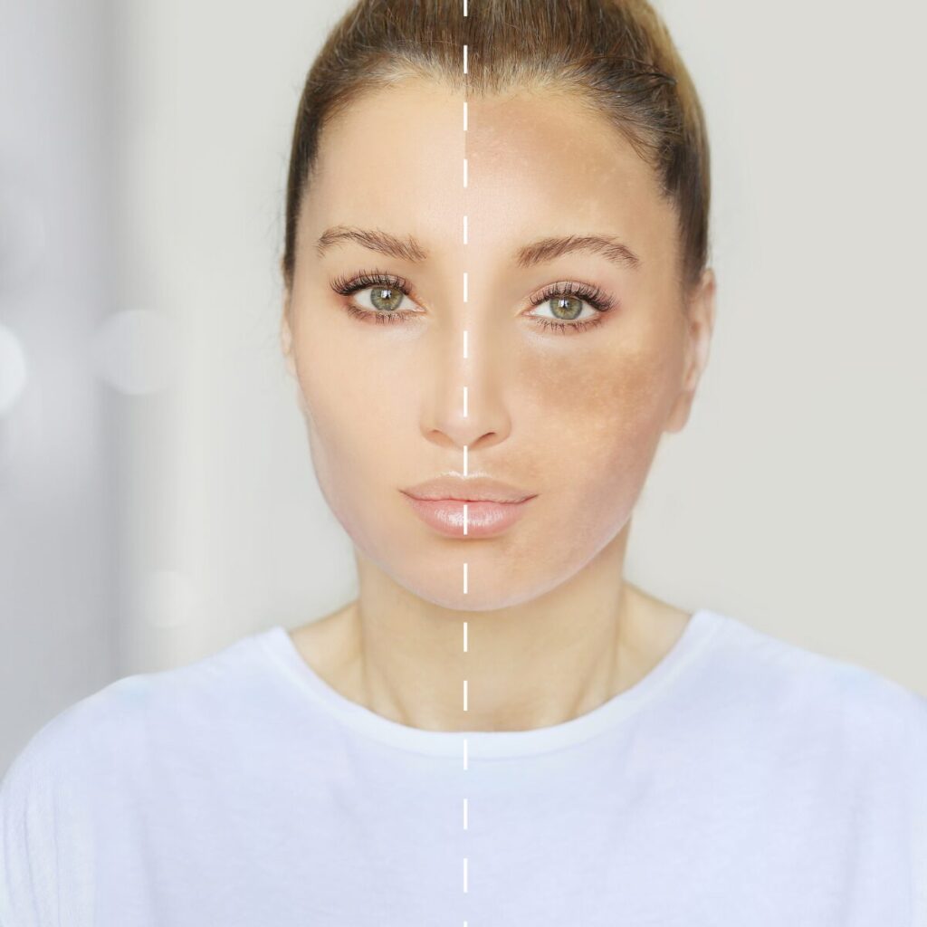 Woman showing clear white skin on half of her face, and hyperpigmentation on the other half.