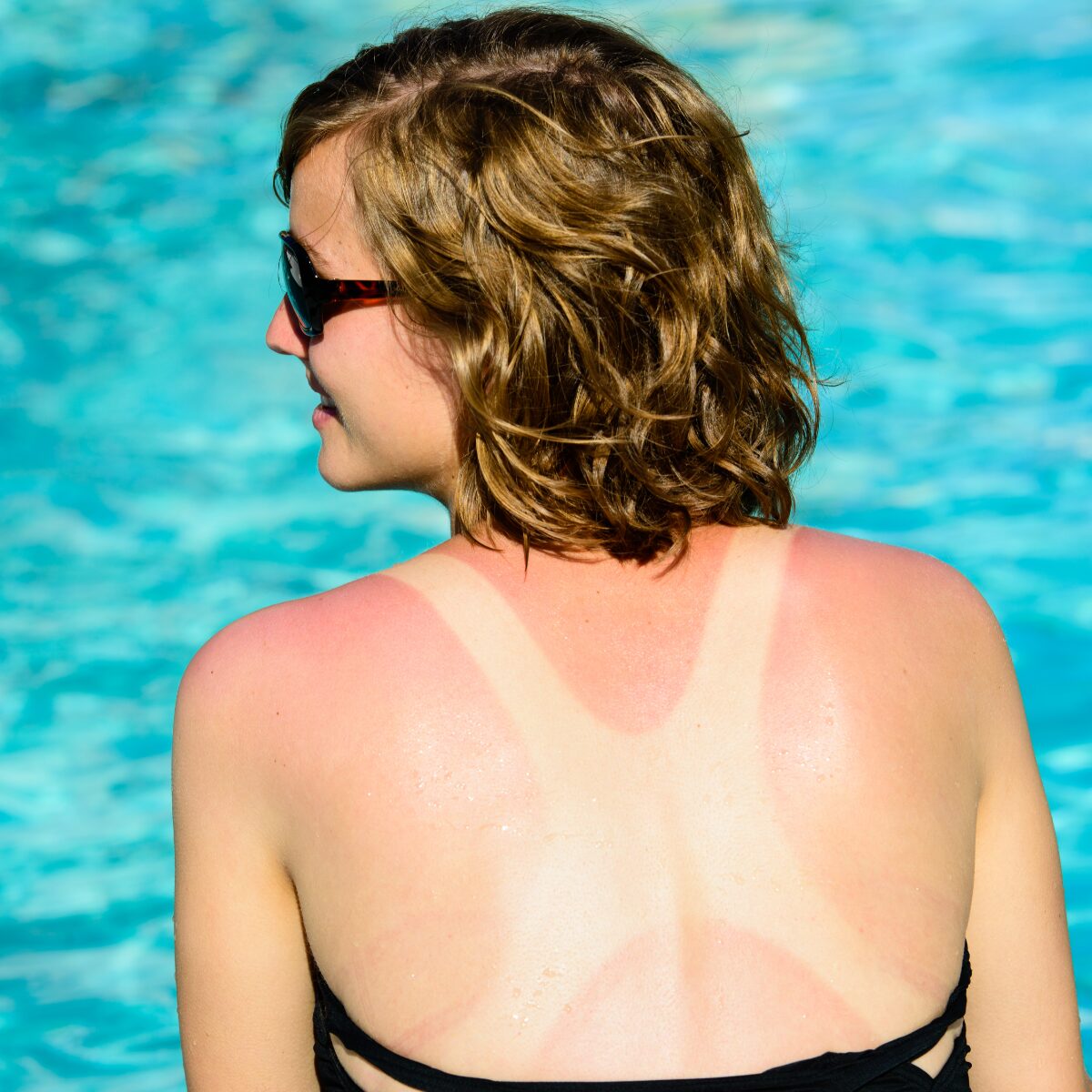 IV Hydration for Sunburn