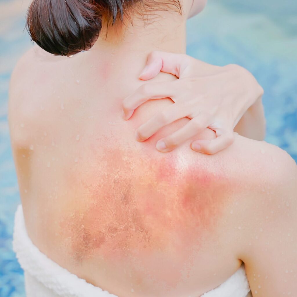 Woman touching her sunburnt back.
