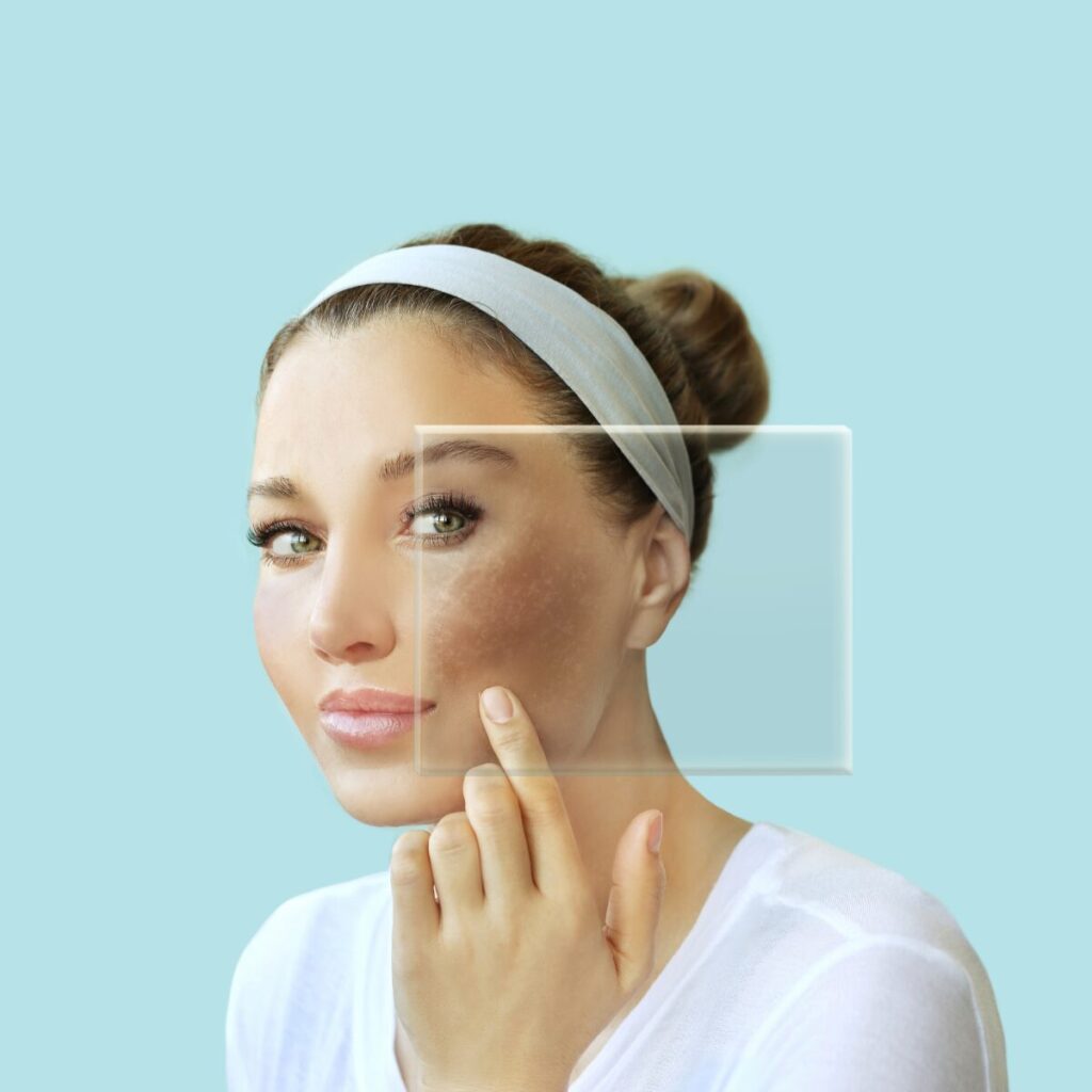 Woman showing hyperpigmentation on her face.